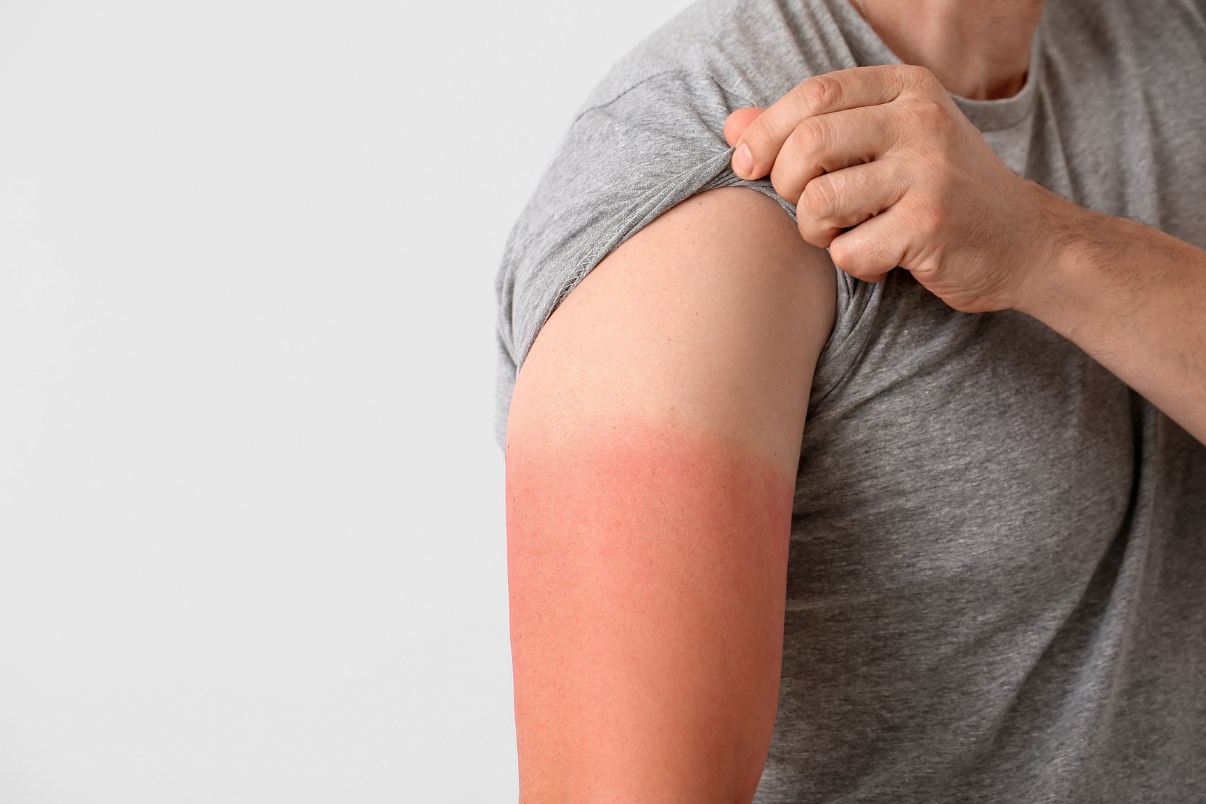 Man with Red Sunburned Skin